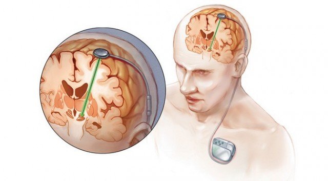 腦起搏器的前世今生