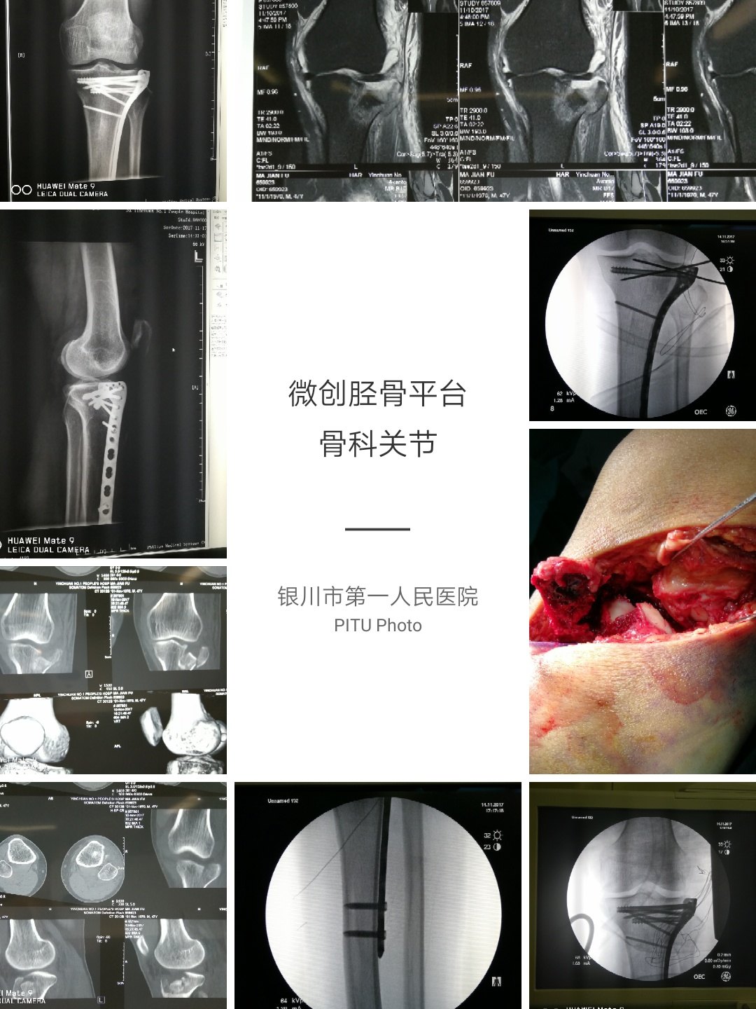 微创胫骨平台骨折及膝关节不稳定手术治疗