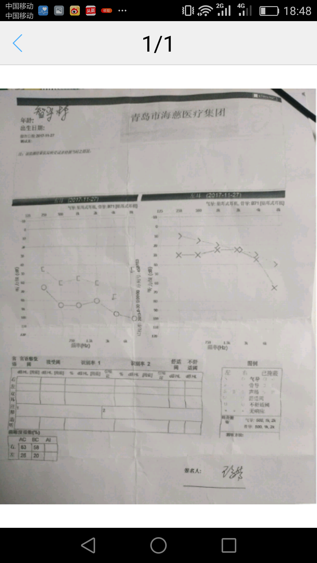 介紹一種安全可靠治療突發性耳聾的方法山東青島