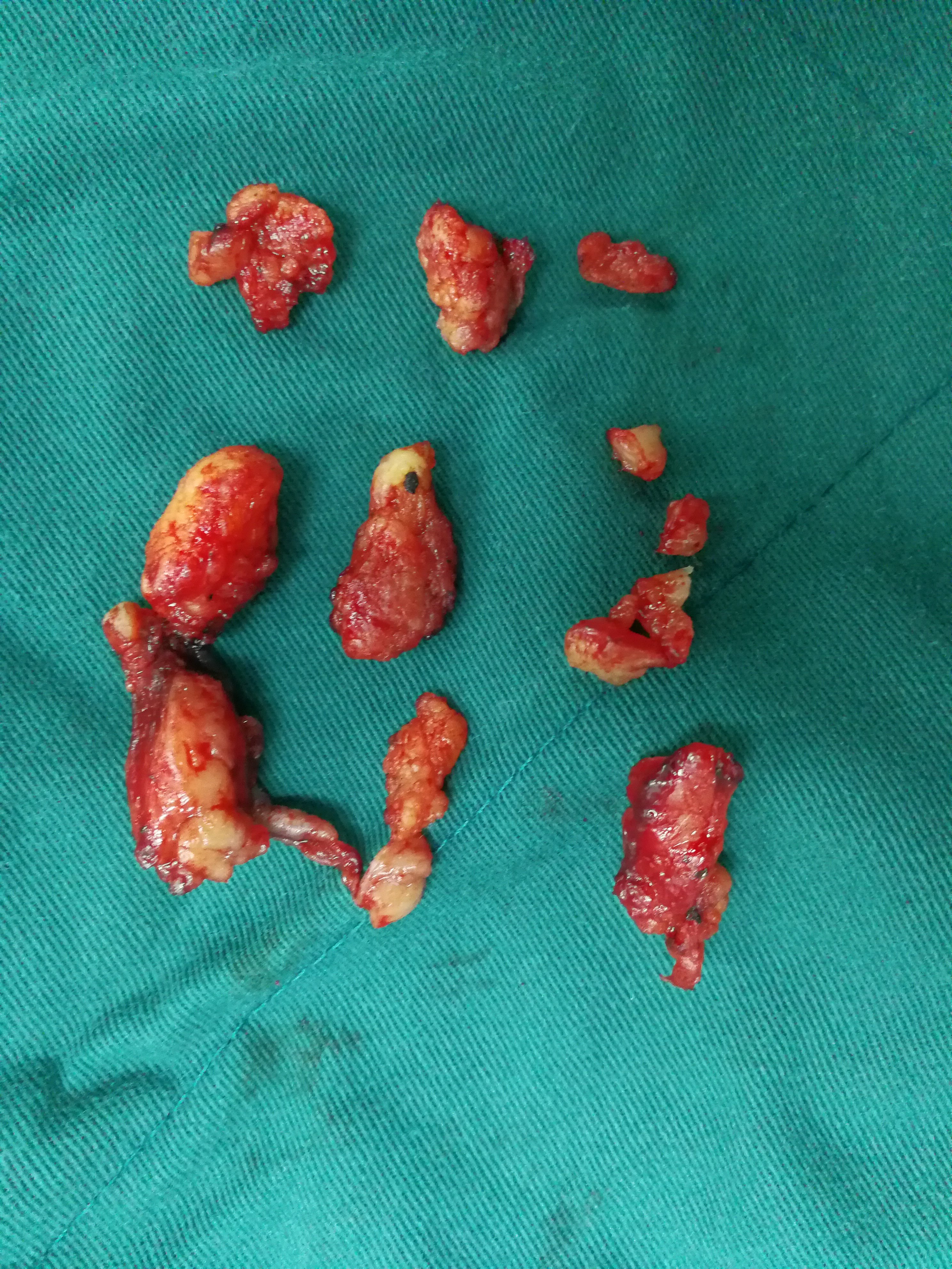 眼睑巨大肿瘤 - 好大夫在线