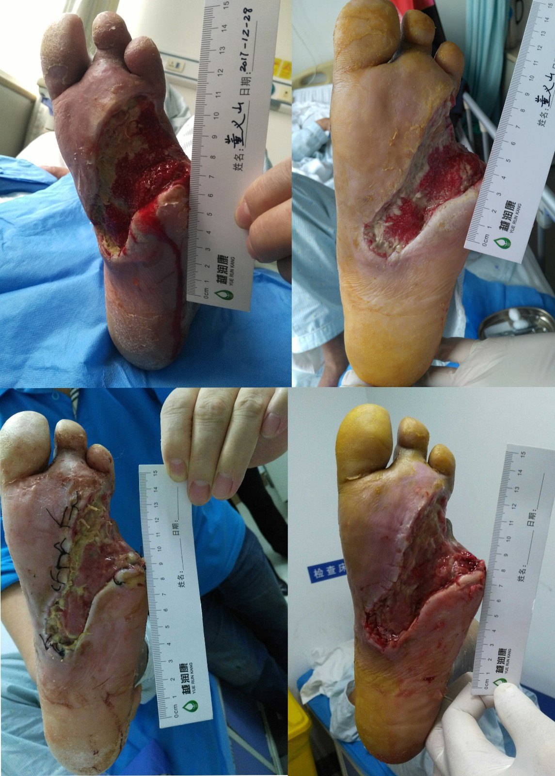 糖尿病足溃疡感染患者经过治疗避免截肢,保存下肢 - 好大夫在线