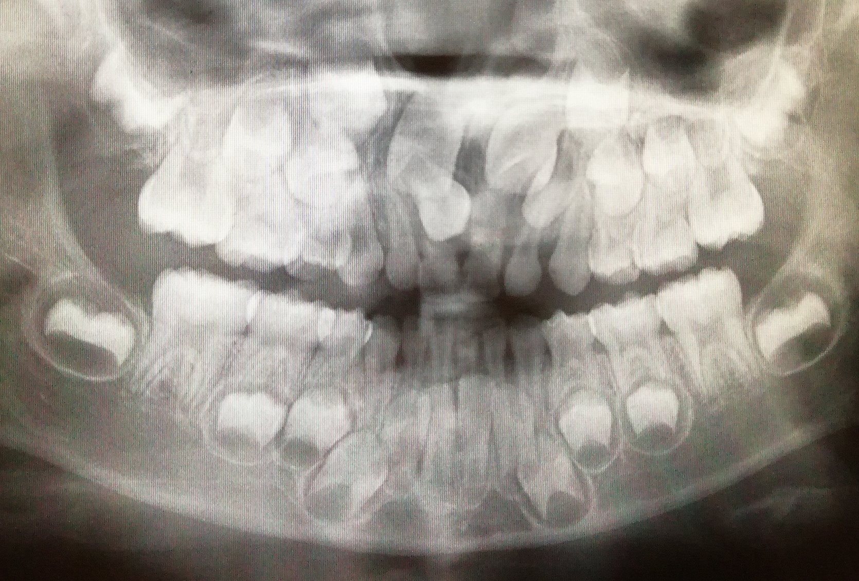 多牙症x光图片