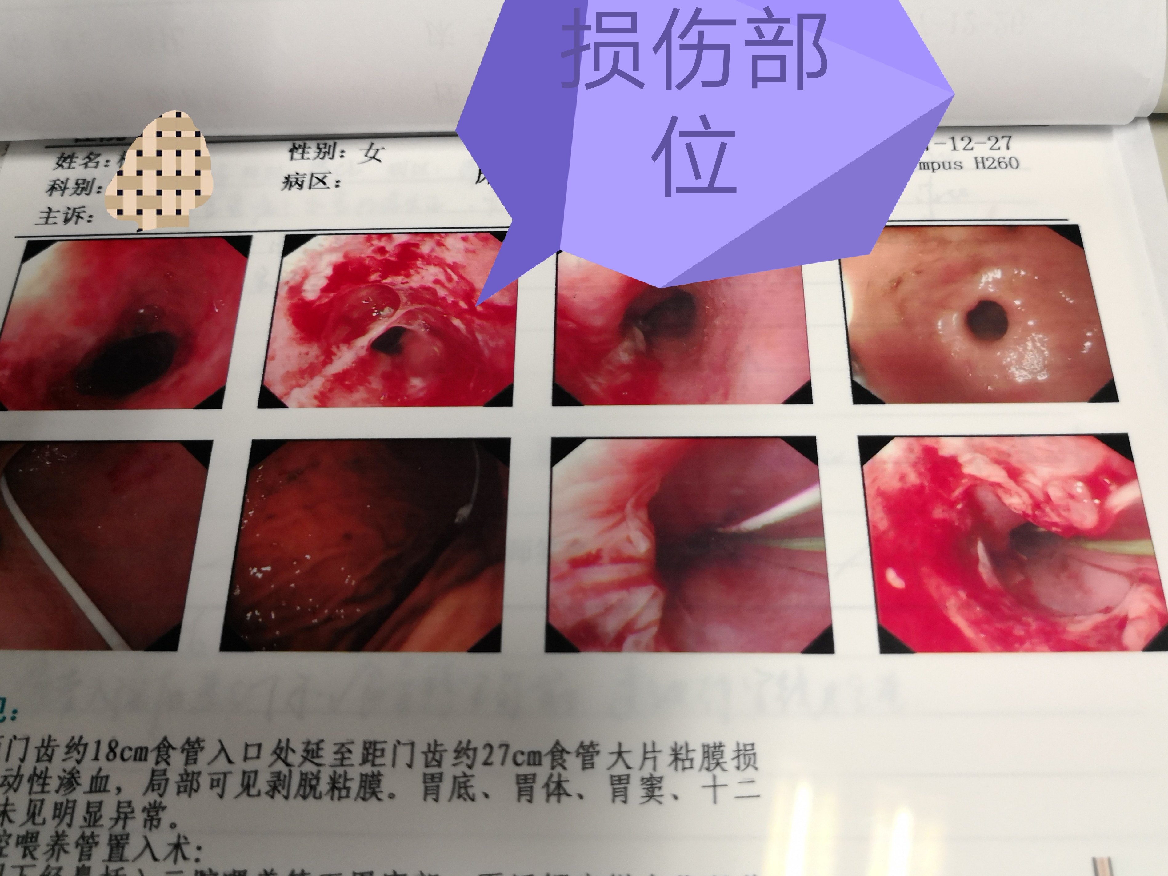 随着吞咽引起的食管很强的推动,较硬的食物就可以轻易损伤你的食管