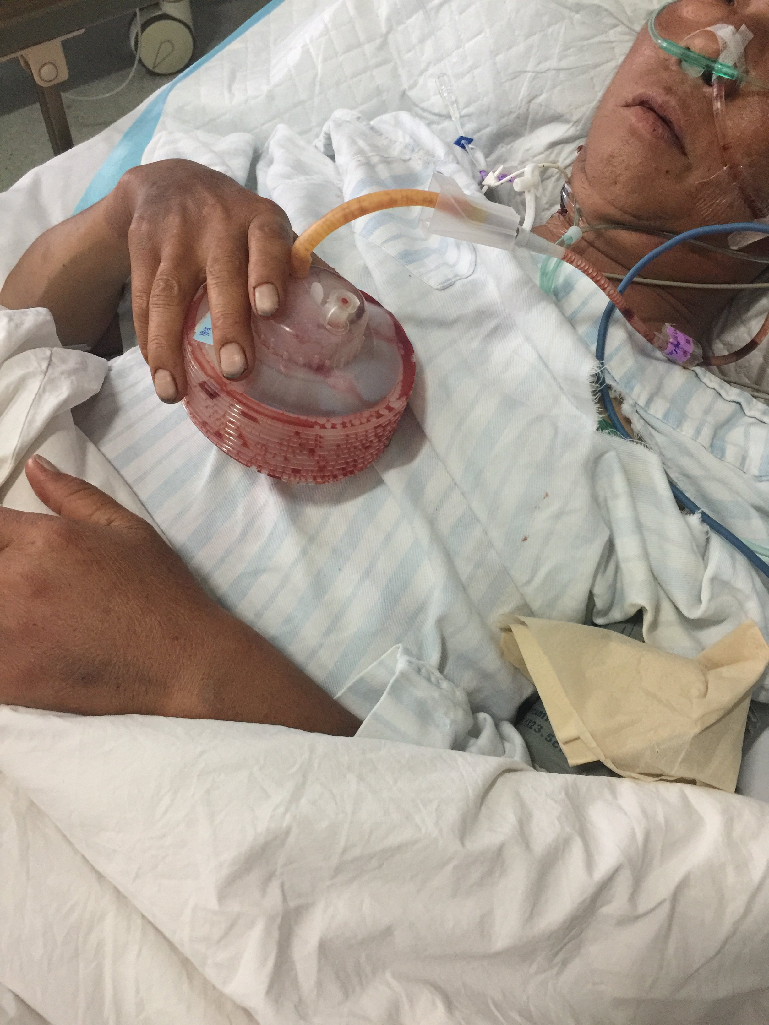 胆管炎发展到感染性休克再到dic - 好大夫在线