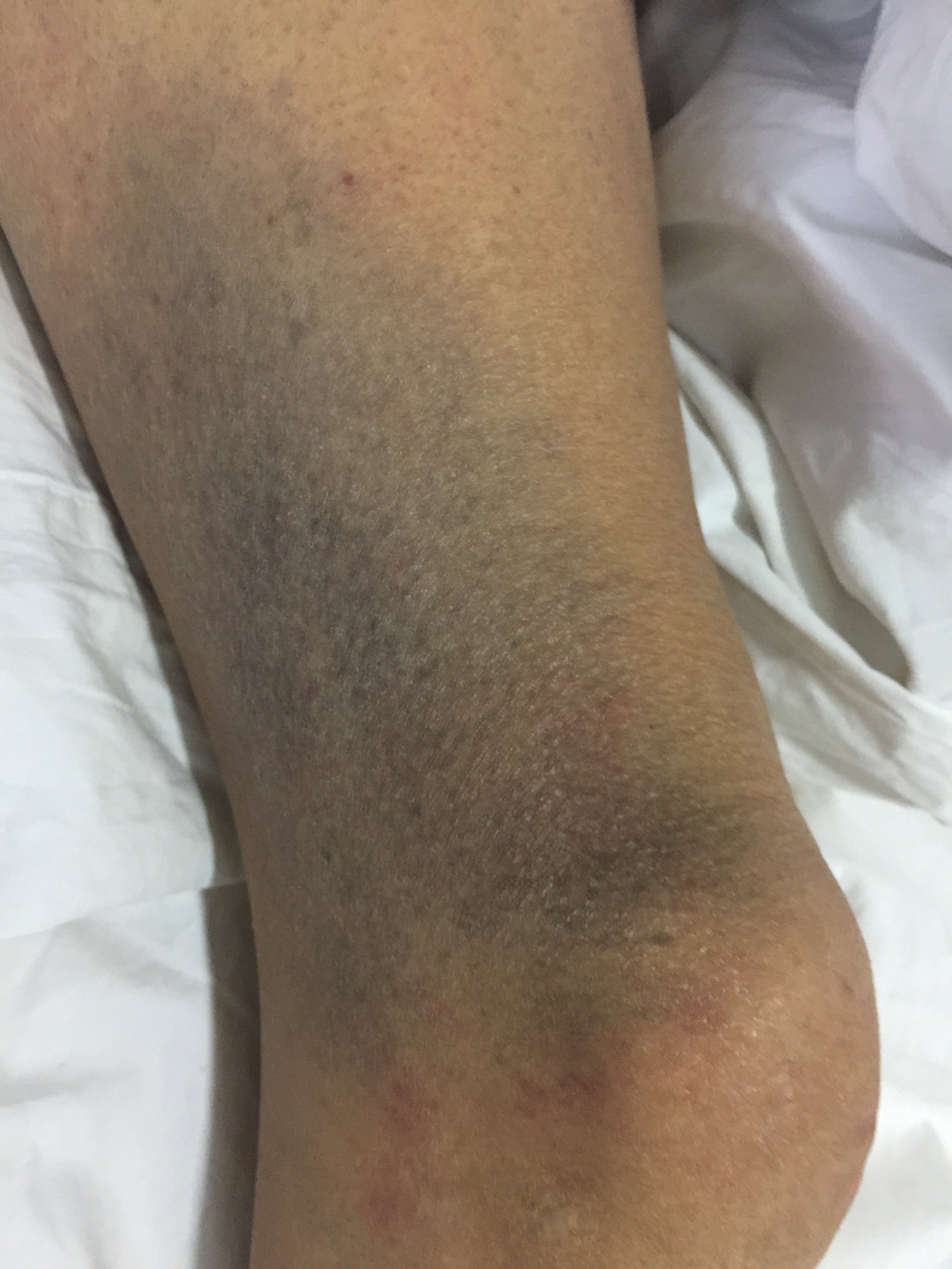 胆管炎发展到感染性休克再到dic