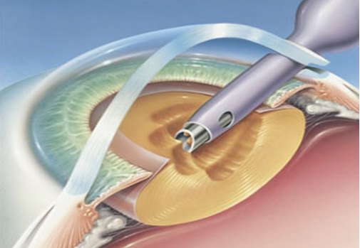 白内障患者如何选择手术时机