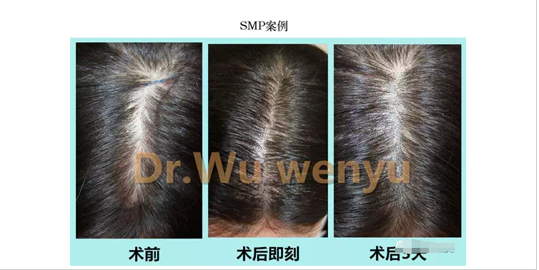 没有毛囊不能植发的 终极秃 该怎么办