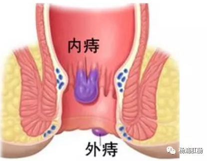 肛周脓肿和痔疮区别图片