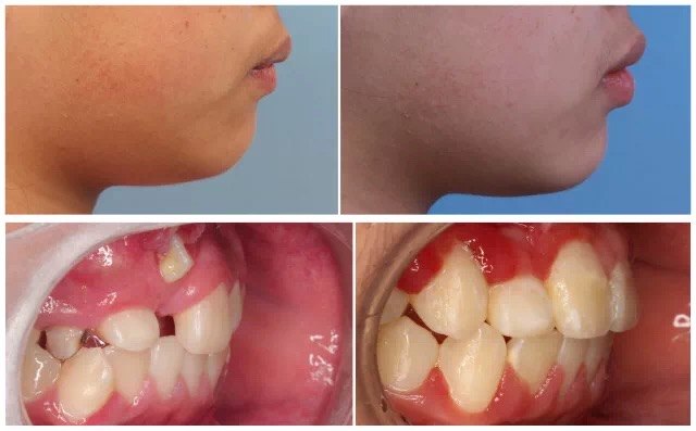埋伏阻生的门牙,尖牙都顺利导萌进入牙弓,使牙齿排列整齐标准.