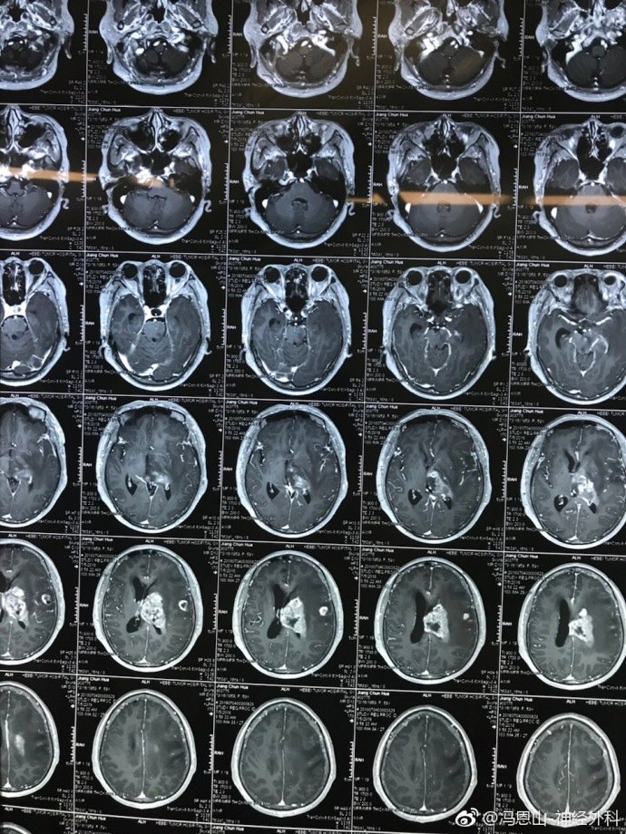 丘脑 CT图片