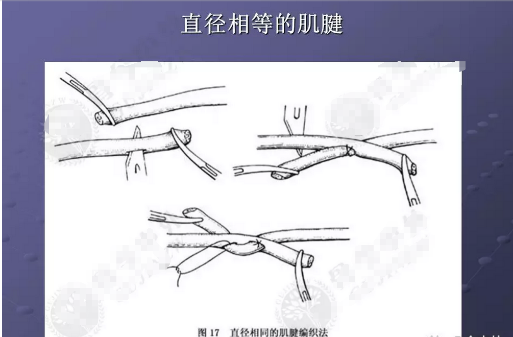 肌腱缝合图解图片