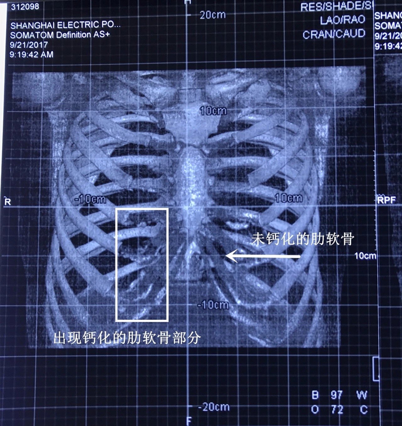 要怎么做鼻综合整形? 