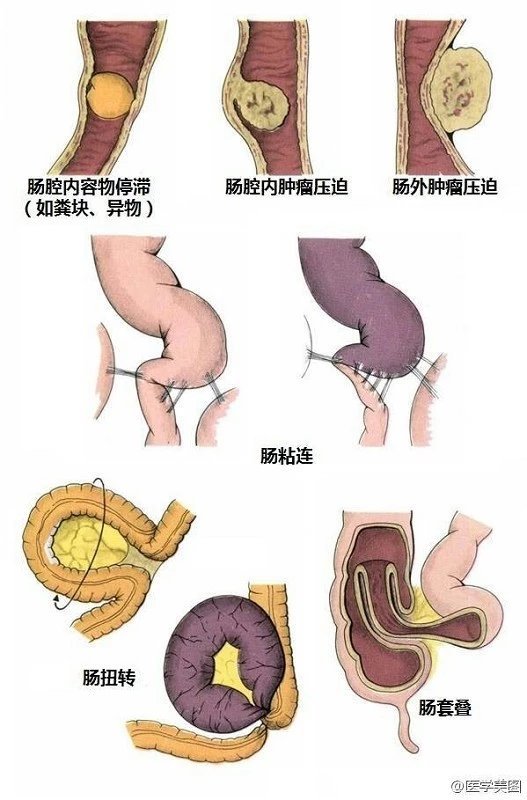 麻痹性肠梗阻图片