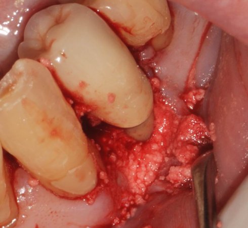 牙齿翻瓣手术图片