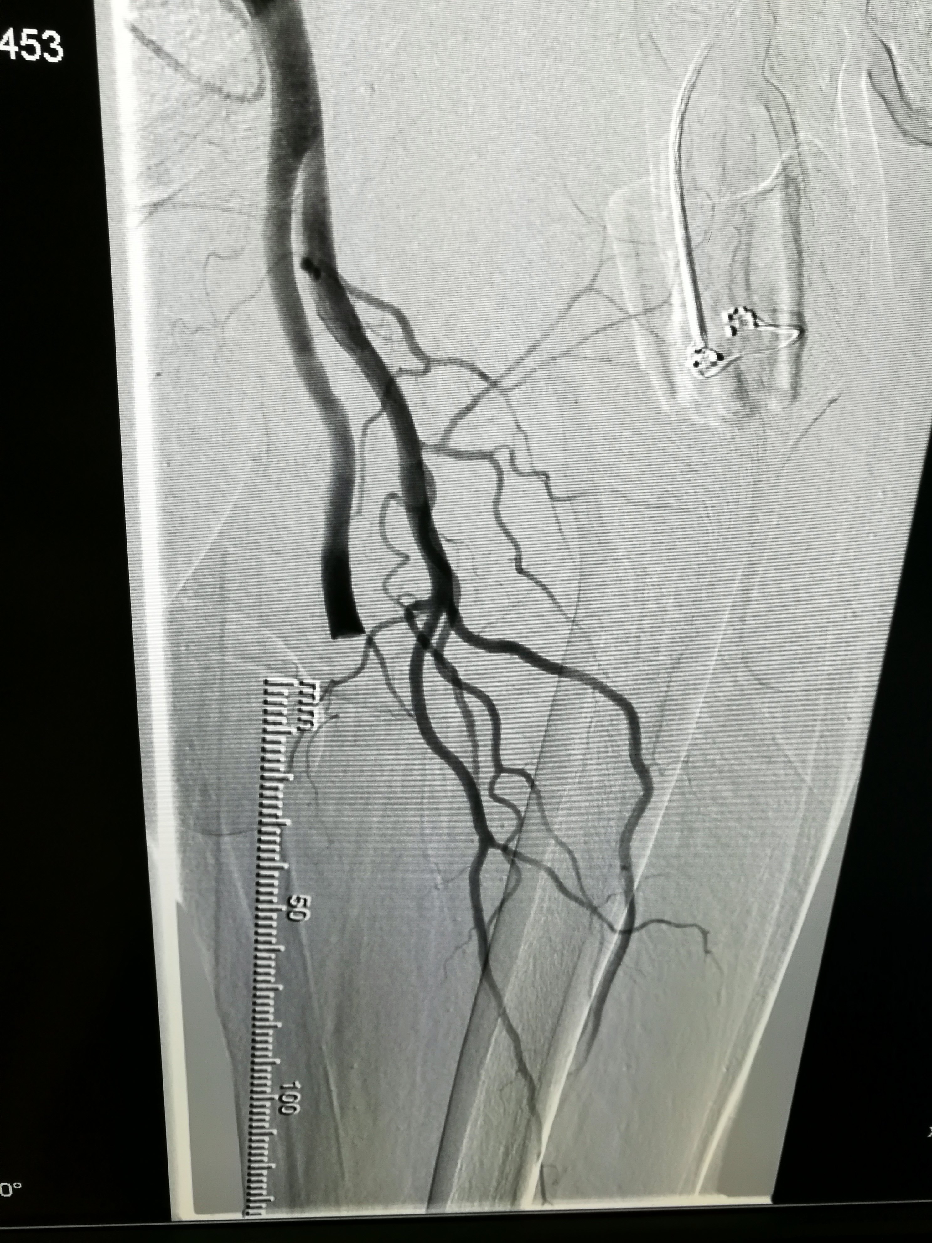 下肢突发疼痛,行走困难,警惕下肢动脉急性血栓!