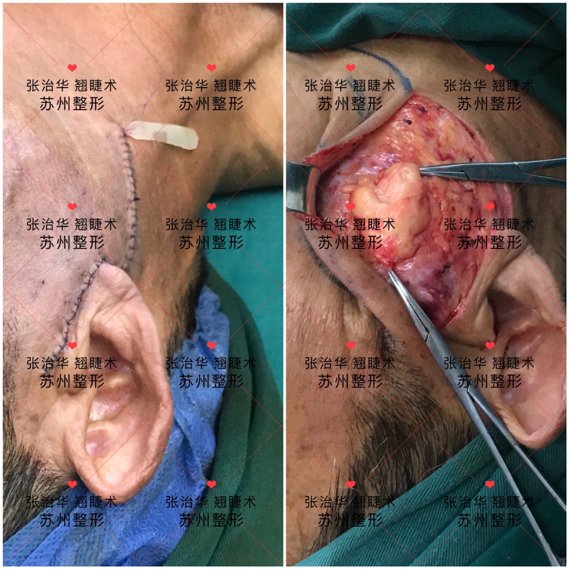 脂肪瘤图片手术过程图片