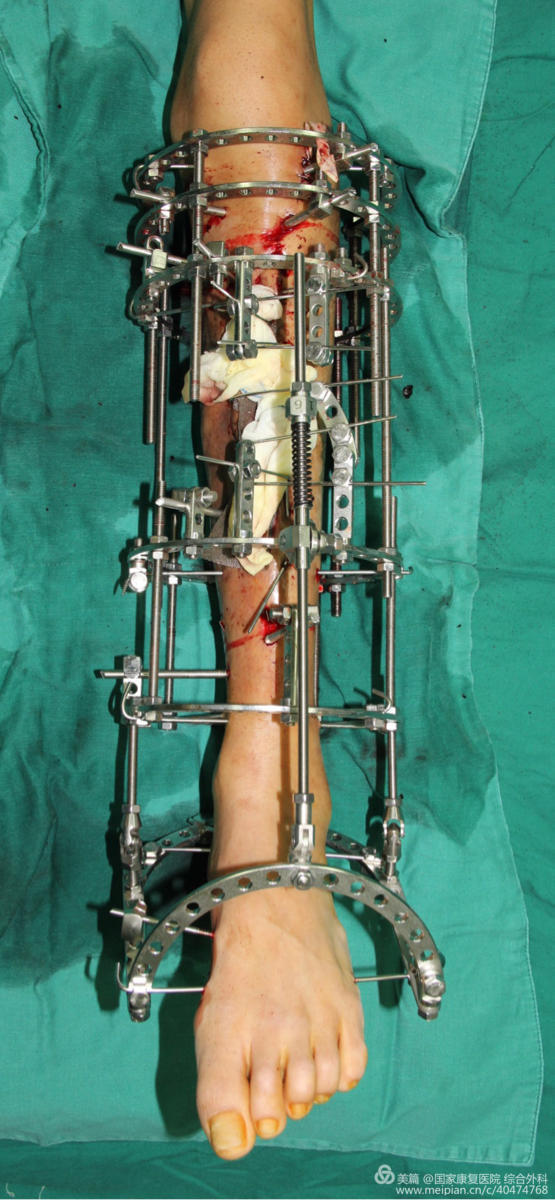 左胫骨骨髓炎-国康医院综合外科一期治疗