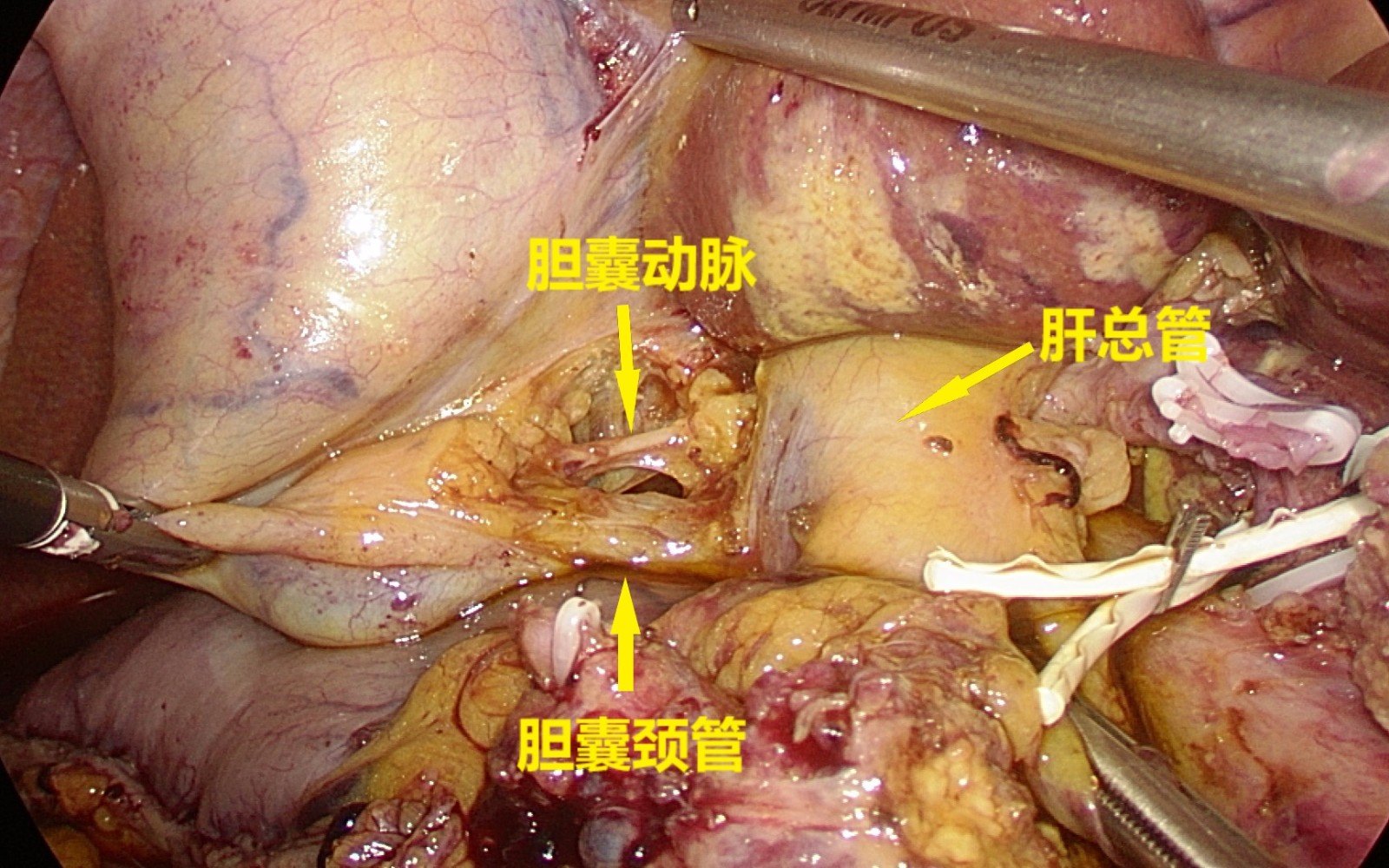 承医附院肝胆外科1周内完成3例腹腔镜胰十二切除术 - 好大夫在线