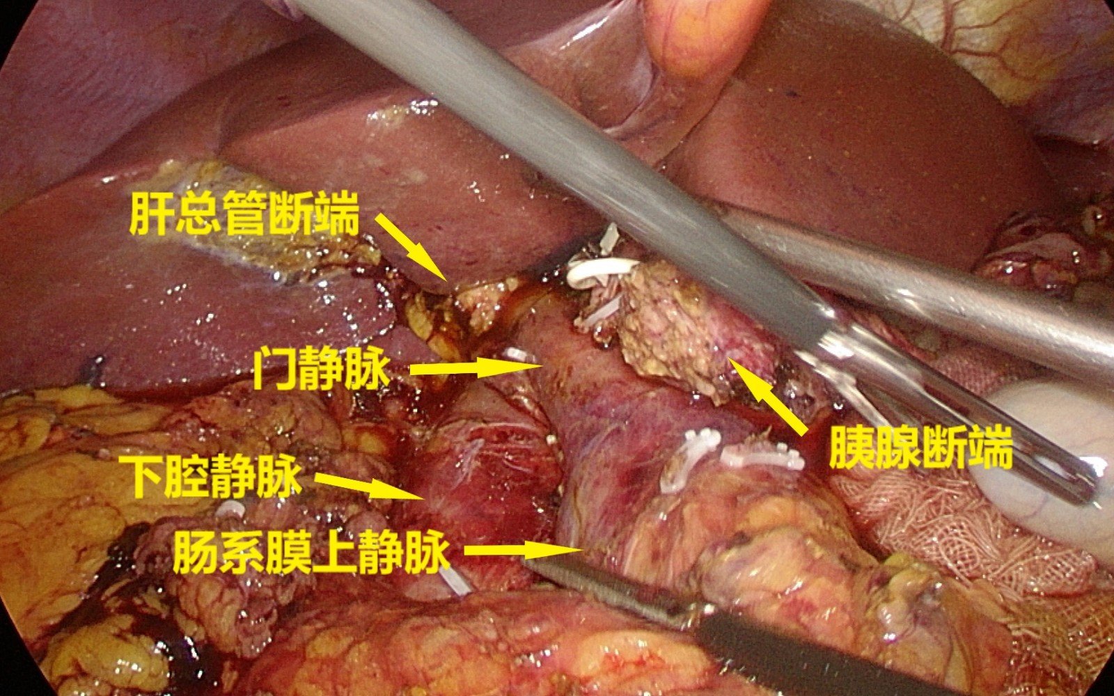 患者,女,54歲,主因體檢發現壺腹部佔位10天入院,入院後查肝膽脾強化ct