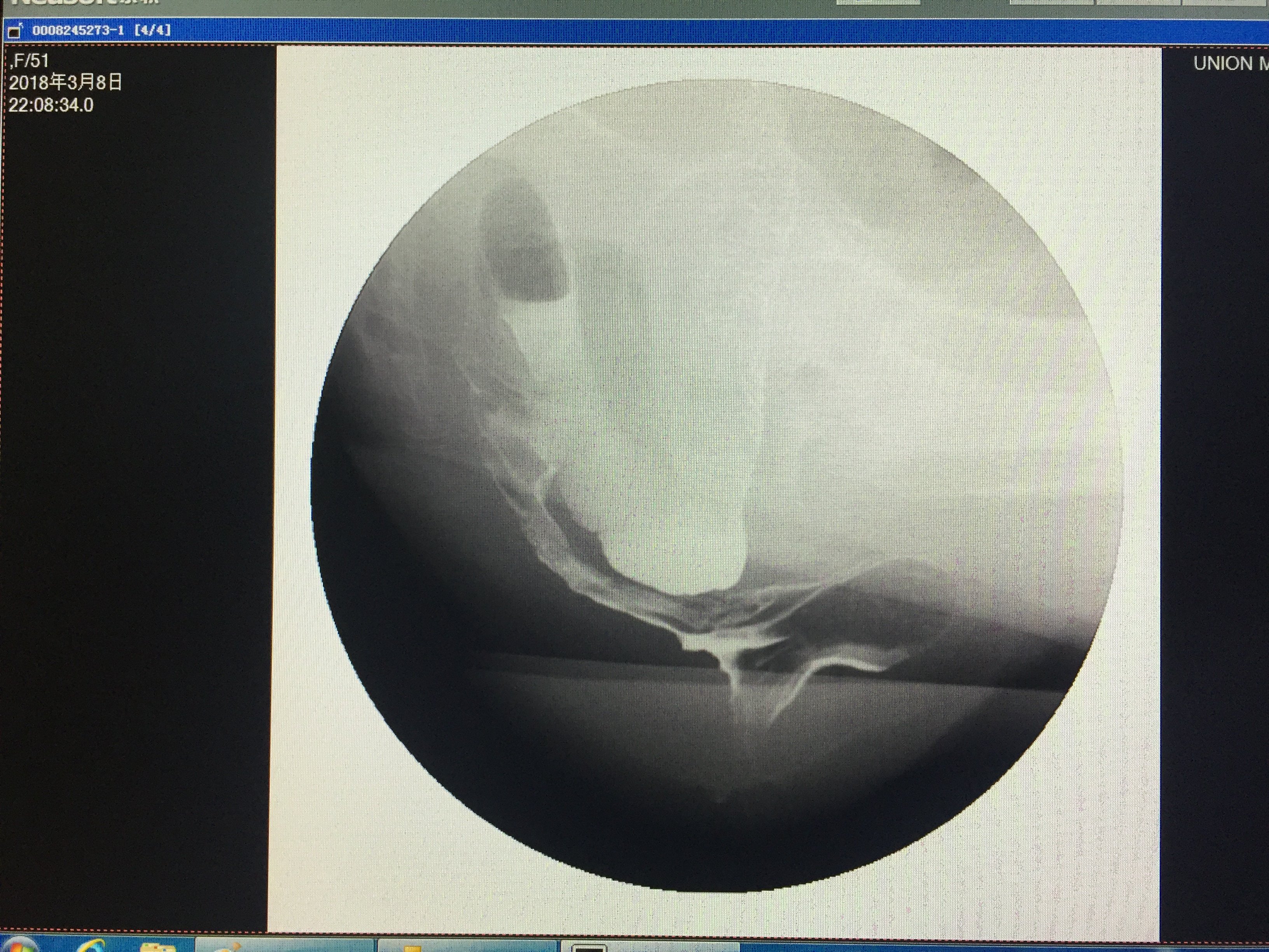 观察直肠前壁观察直肠后方观察肠粘膜观察标记物观察残留物数量与前一