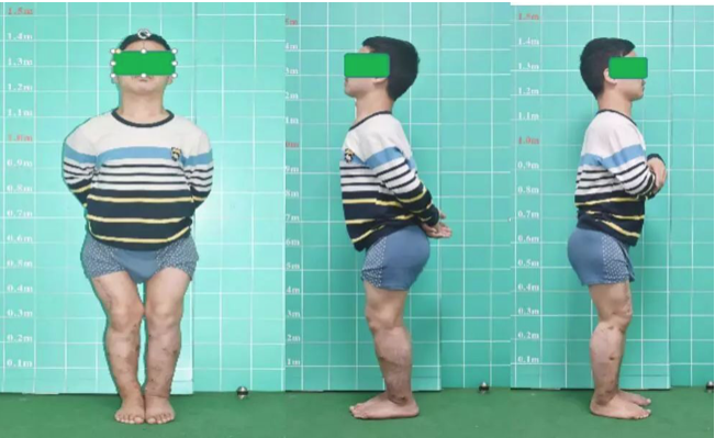 儿童重度佝偻病双下肢复杂畸形的矫正