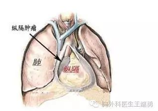 纵隔肿瘤