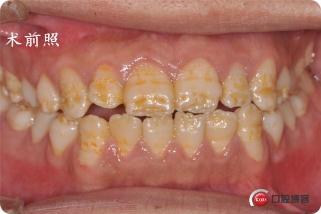 牙齿釉质发育不全知多少? 