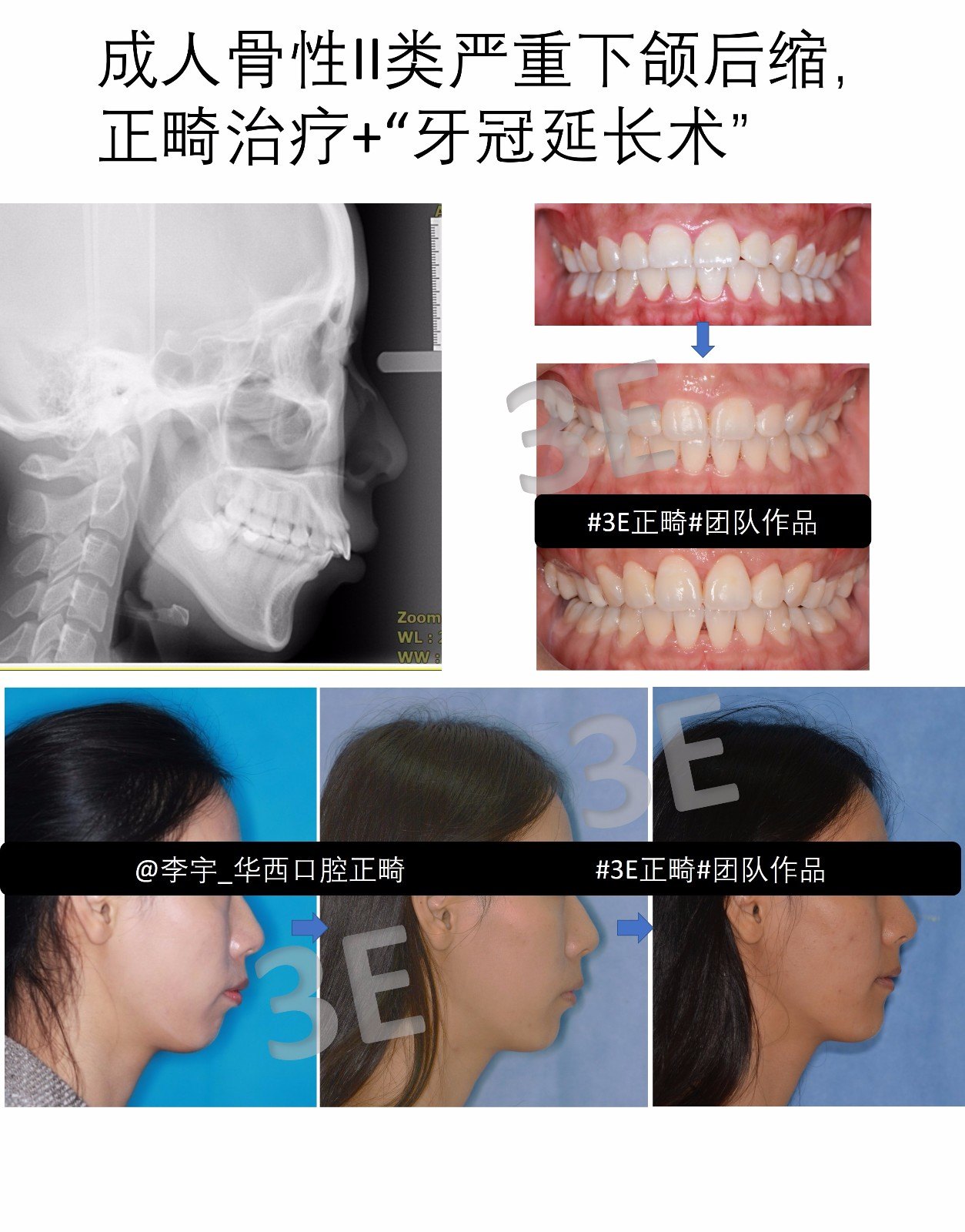 后牙骨性图片