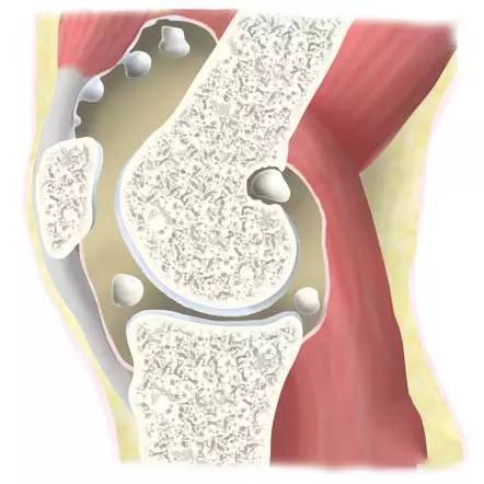 疾病科普(1)滑膜炎,我该拿你怎么办?