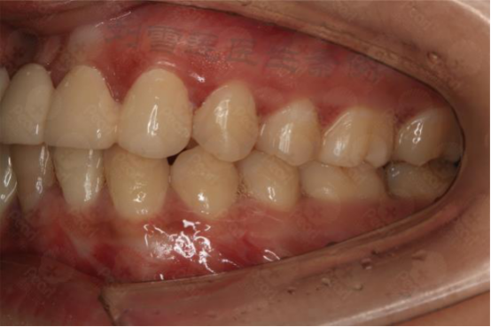 牙齿矫正病例分析——牙列不齐,牙体缺失,咬合不良 - 好大夫在线