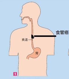 图2为胃切除的范围,最后胃制作成管状,图3位胃代替食管与上段食管吻合