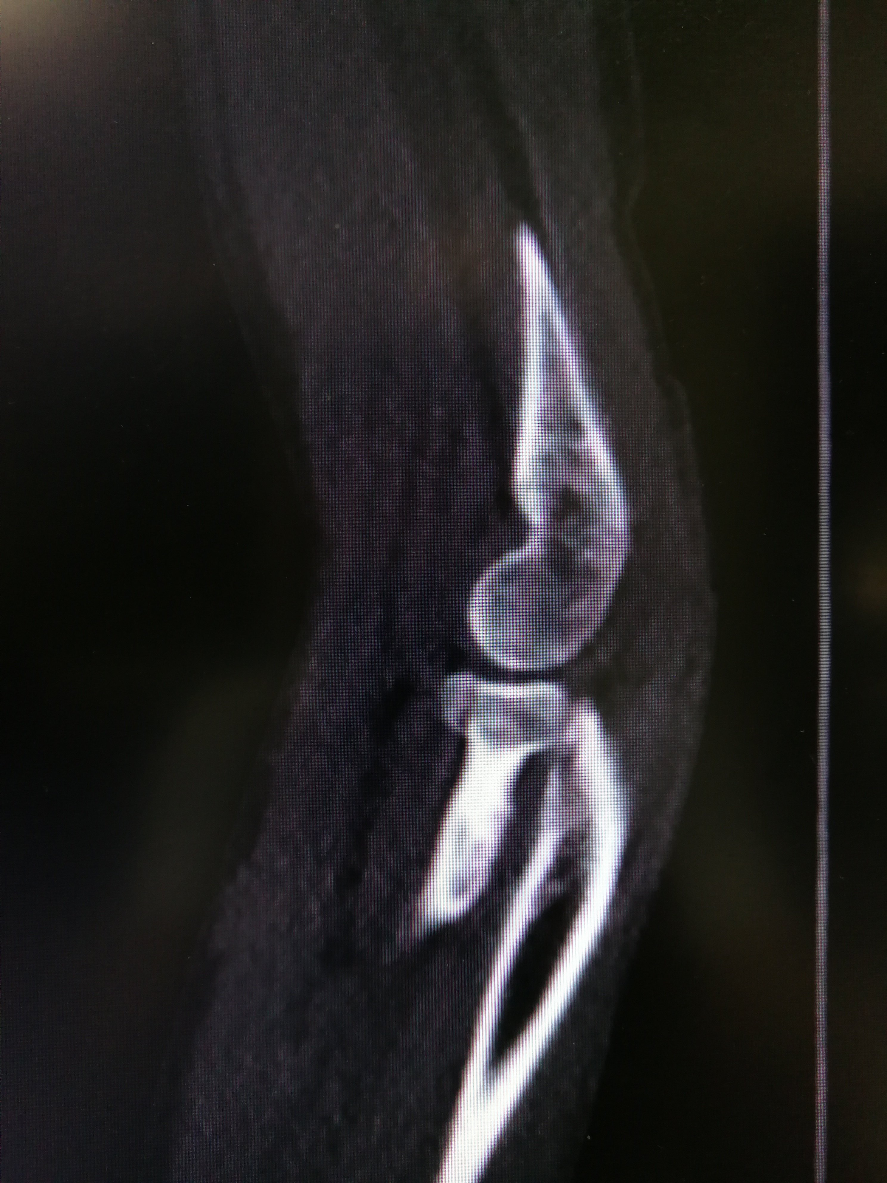 左桡骨下段骨折图片图片