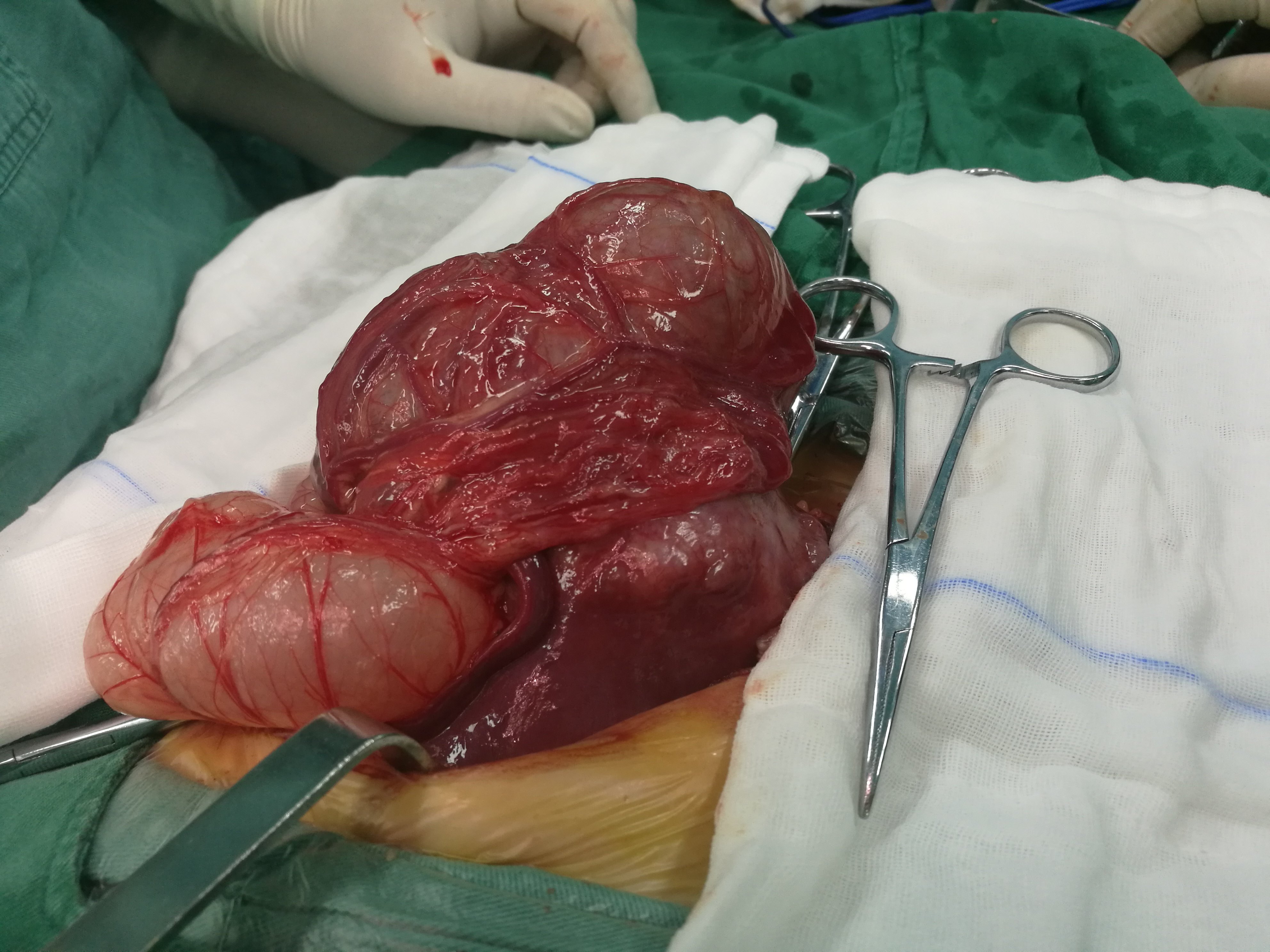 肝母细胞瘤肚子图片图片