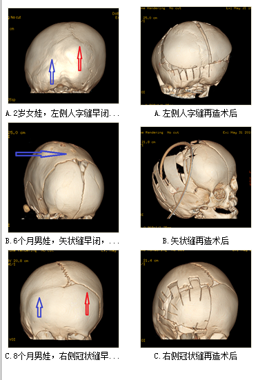 警惕儿童颅缝早闭