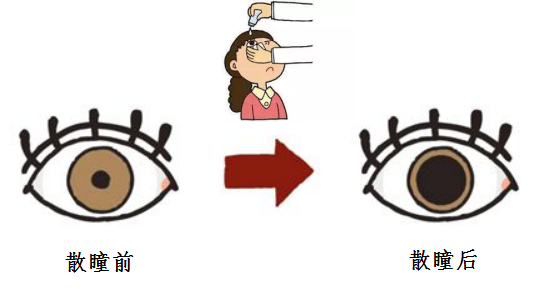 散瞳后注意事项图片