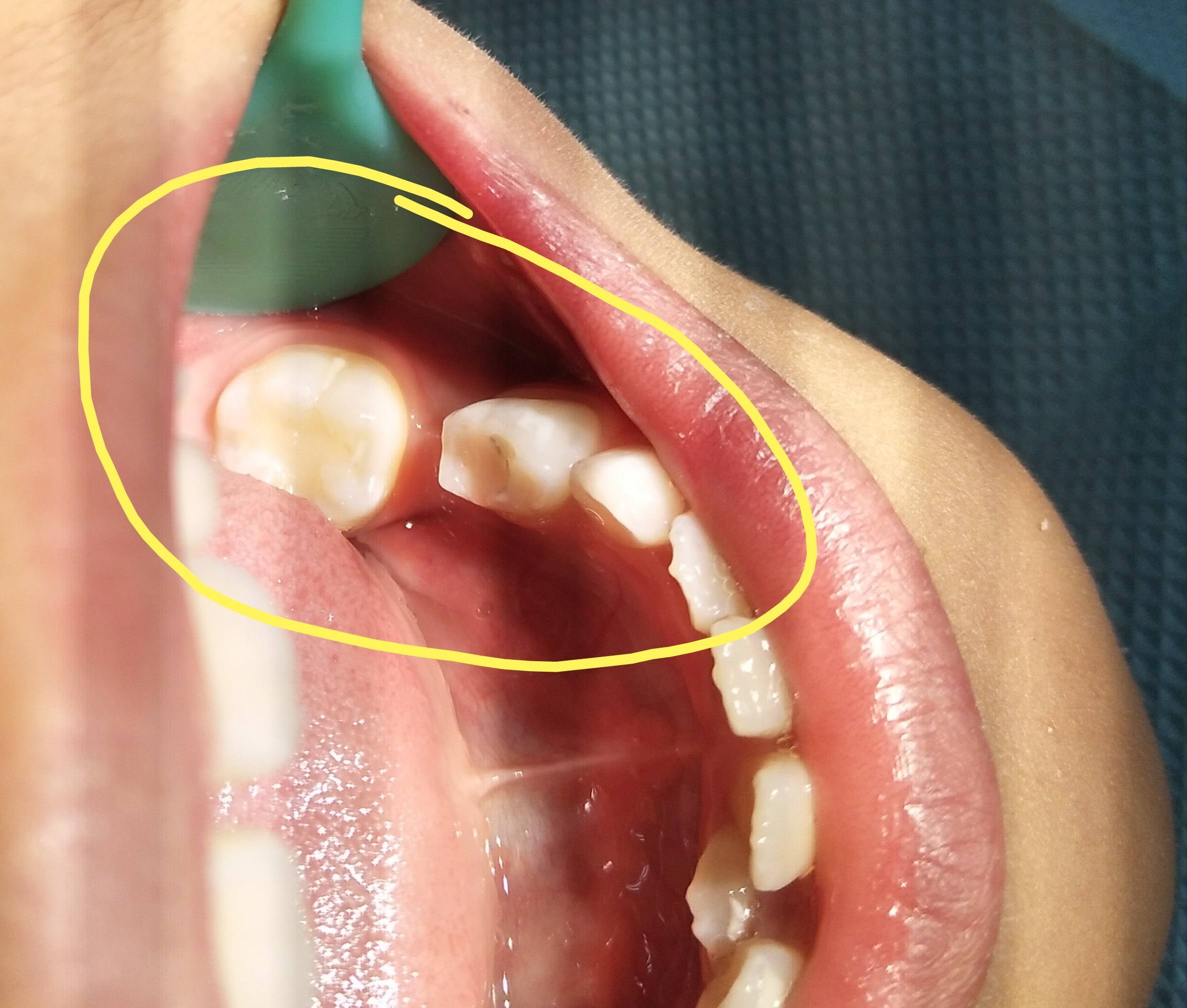 年轻恒牙嵌入性脱位图片