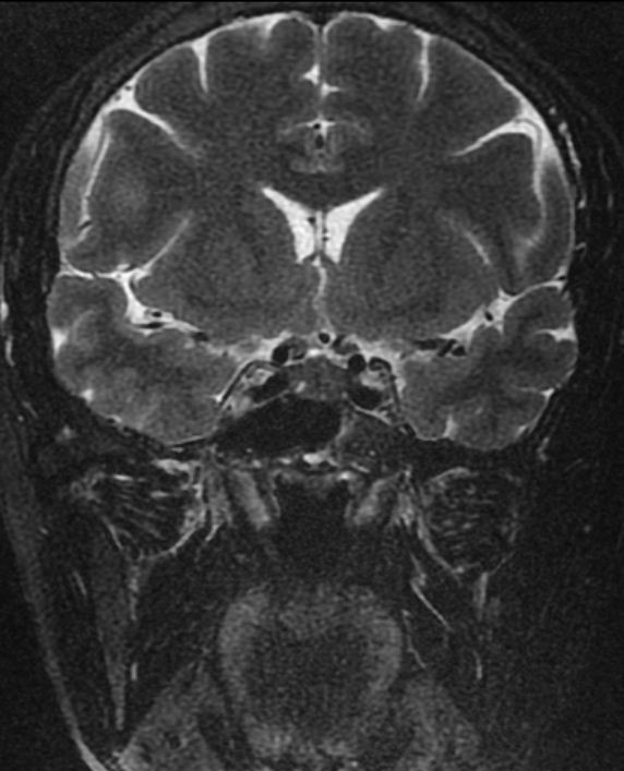 经鼻微创手术治疗泌乳素型垂体瘤
