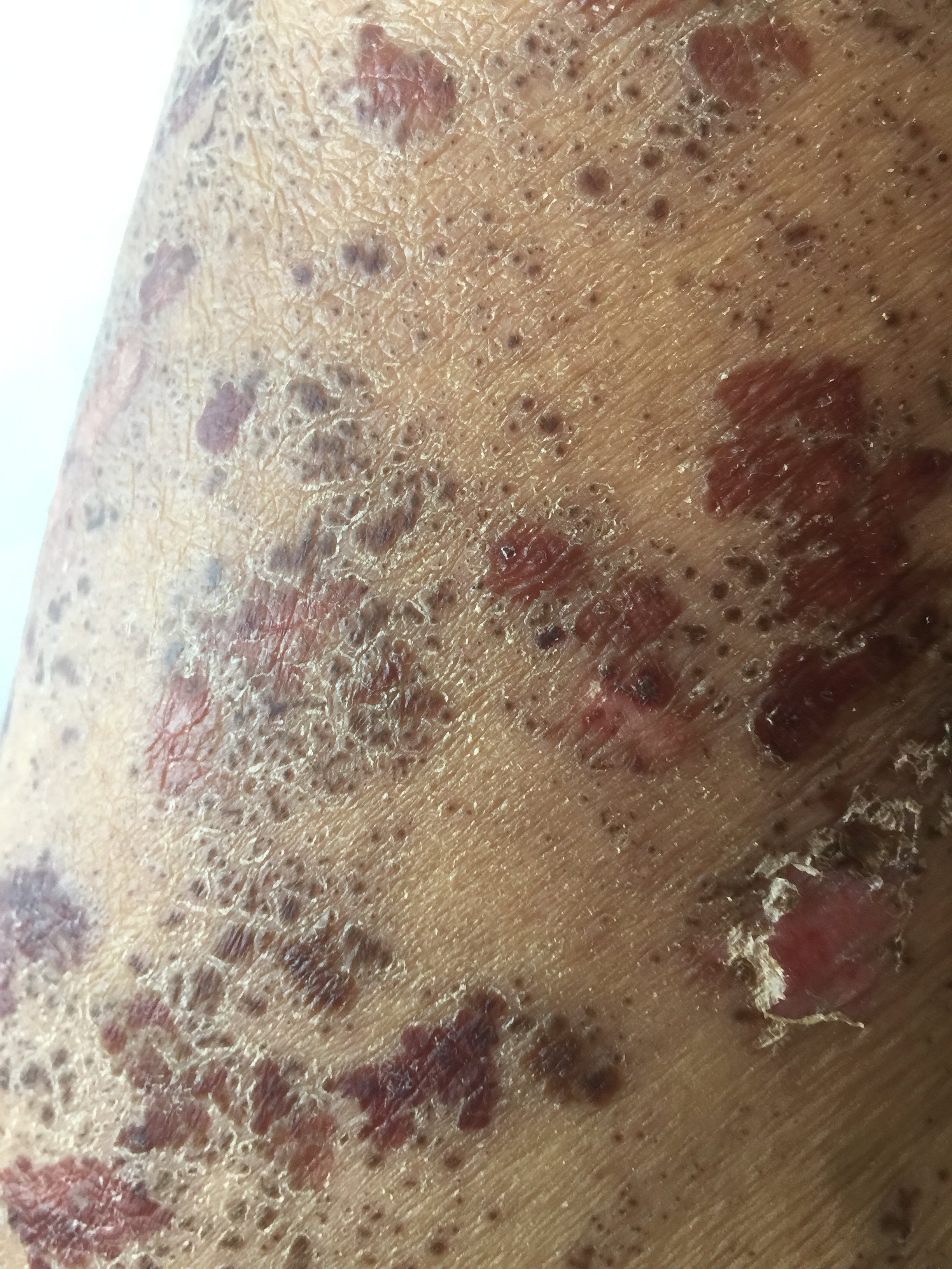 带状疱疹留下的疤痕图图片