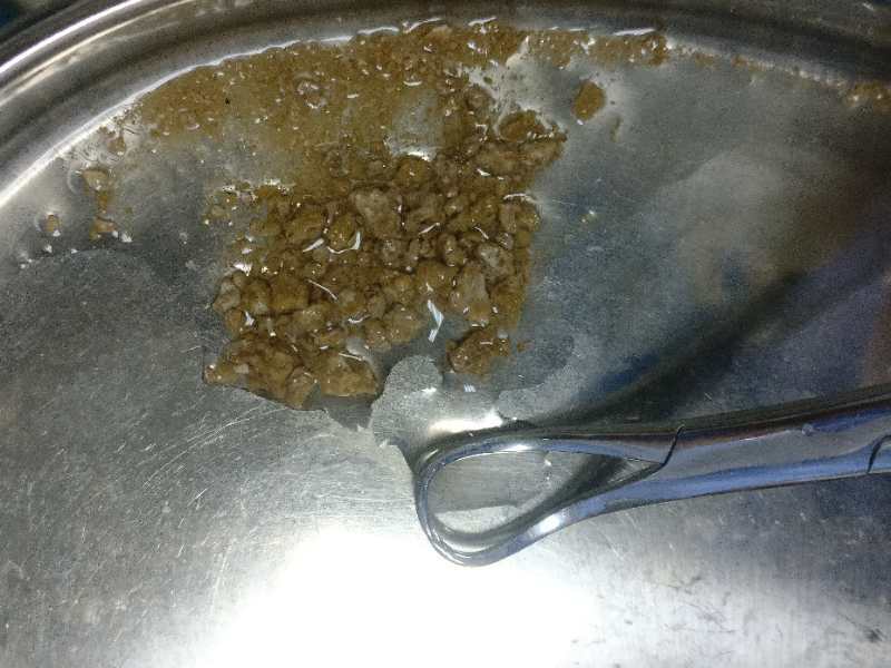 微通道经皮肾镜取石打个小洞取结石