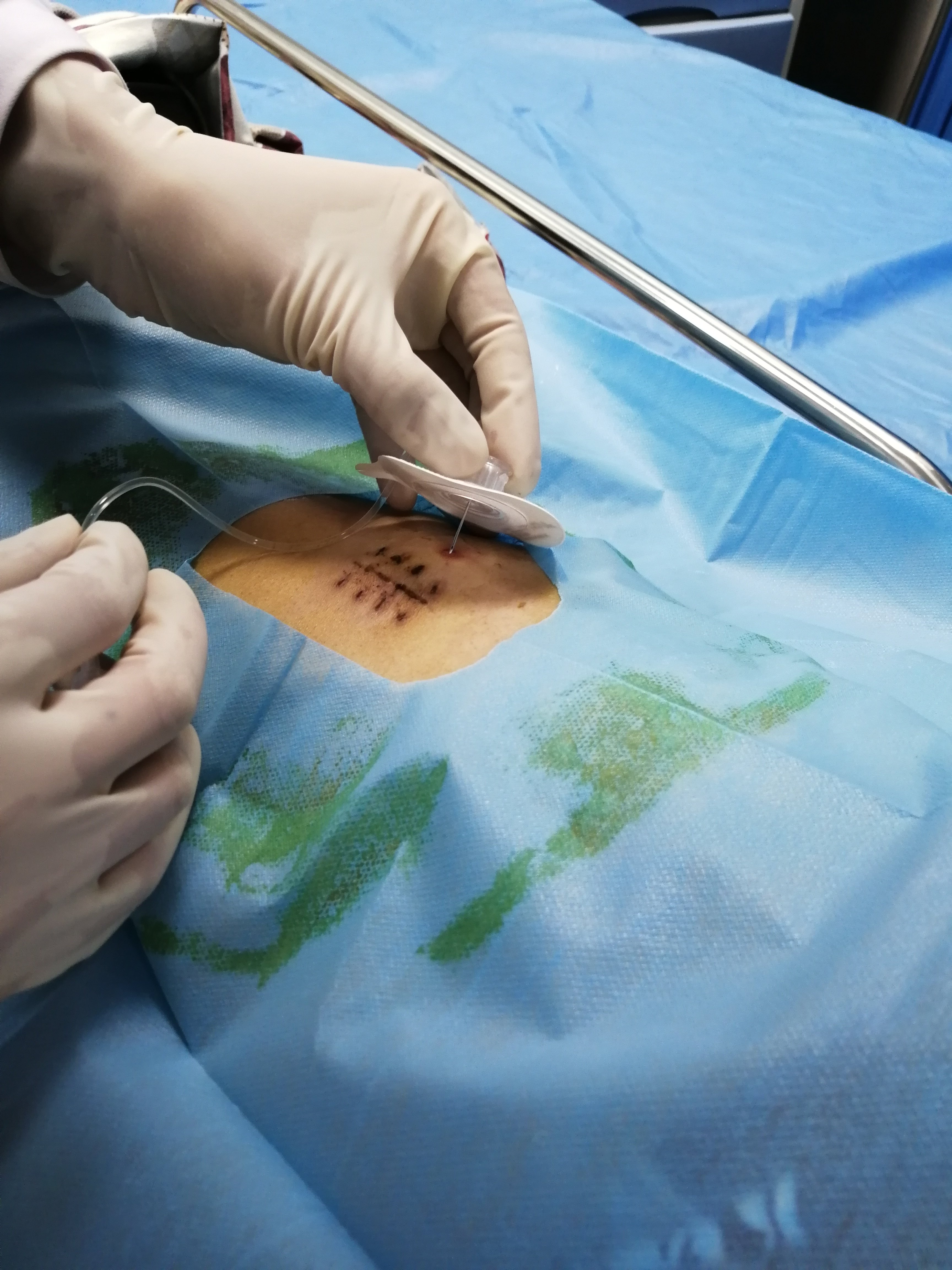 癌痛患者痛不欲生～鞘内泵术如获重生 - 好大夫在线