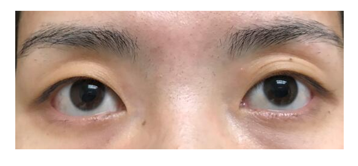 李斌斌手术实例——眶隔脂肪重置,上睑凹陷矫正详解及案例_眼部整形