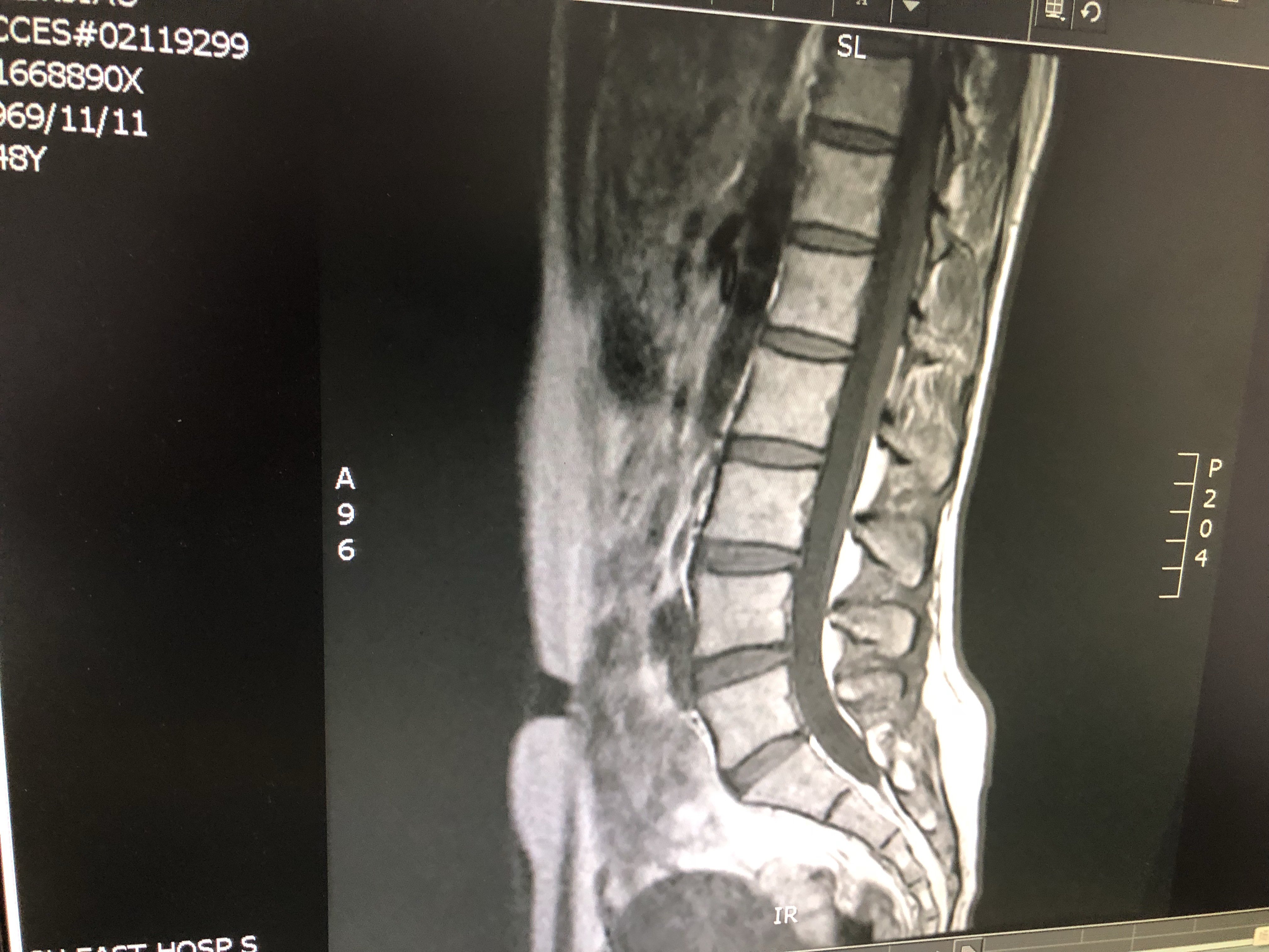 腰疼及腰肌勞損的預防和治療