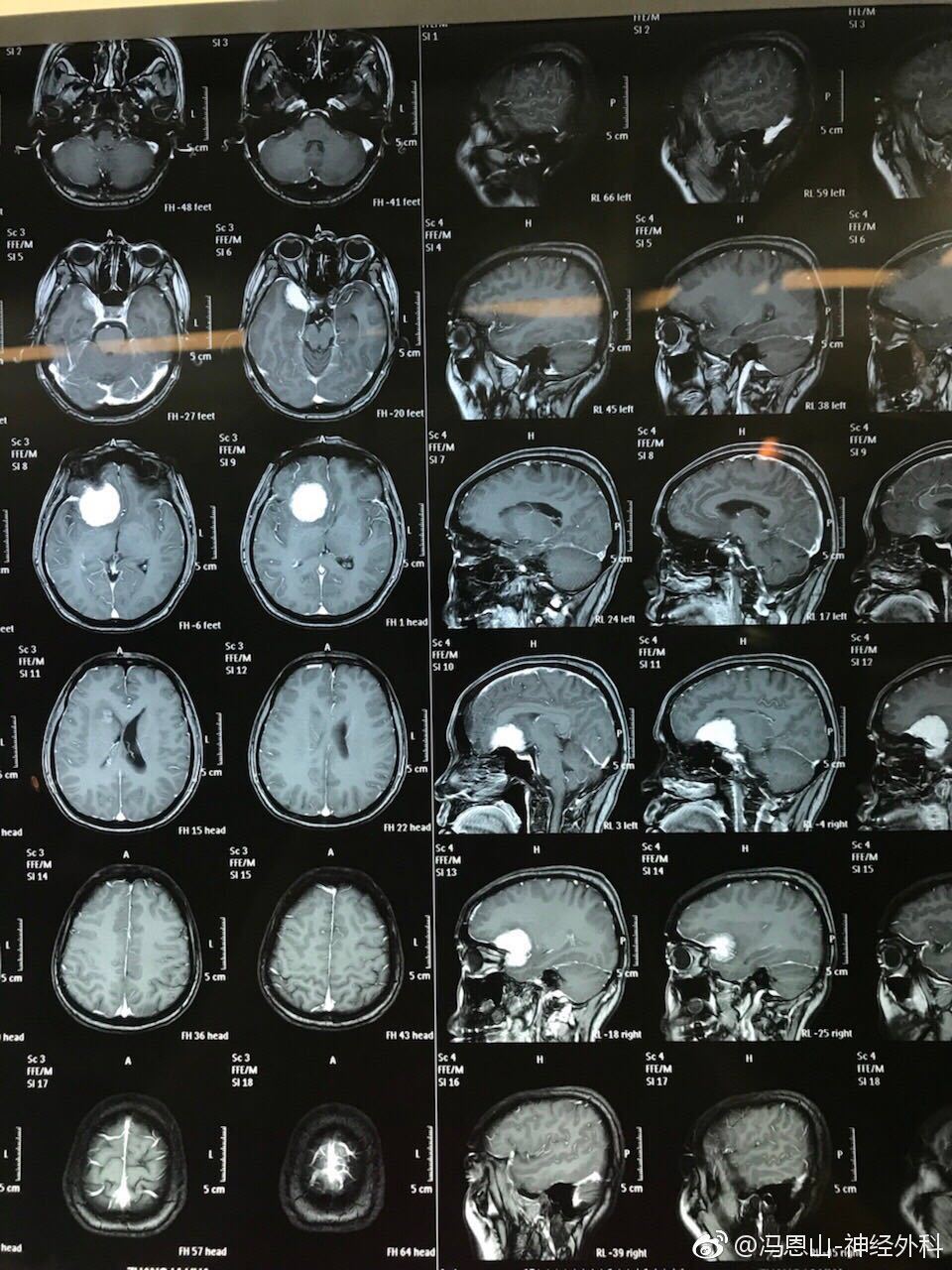 蝶骨嵴脑膜瘤图片图片