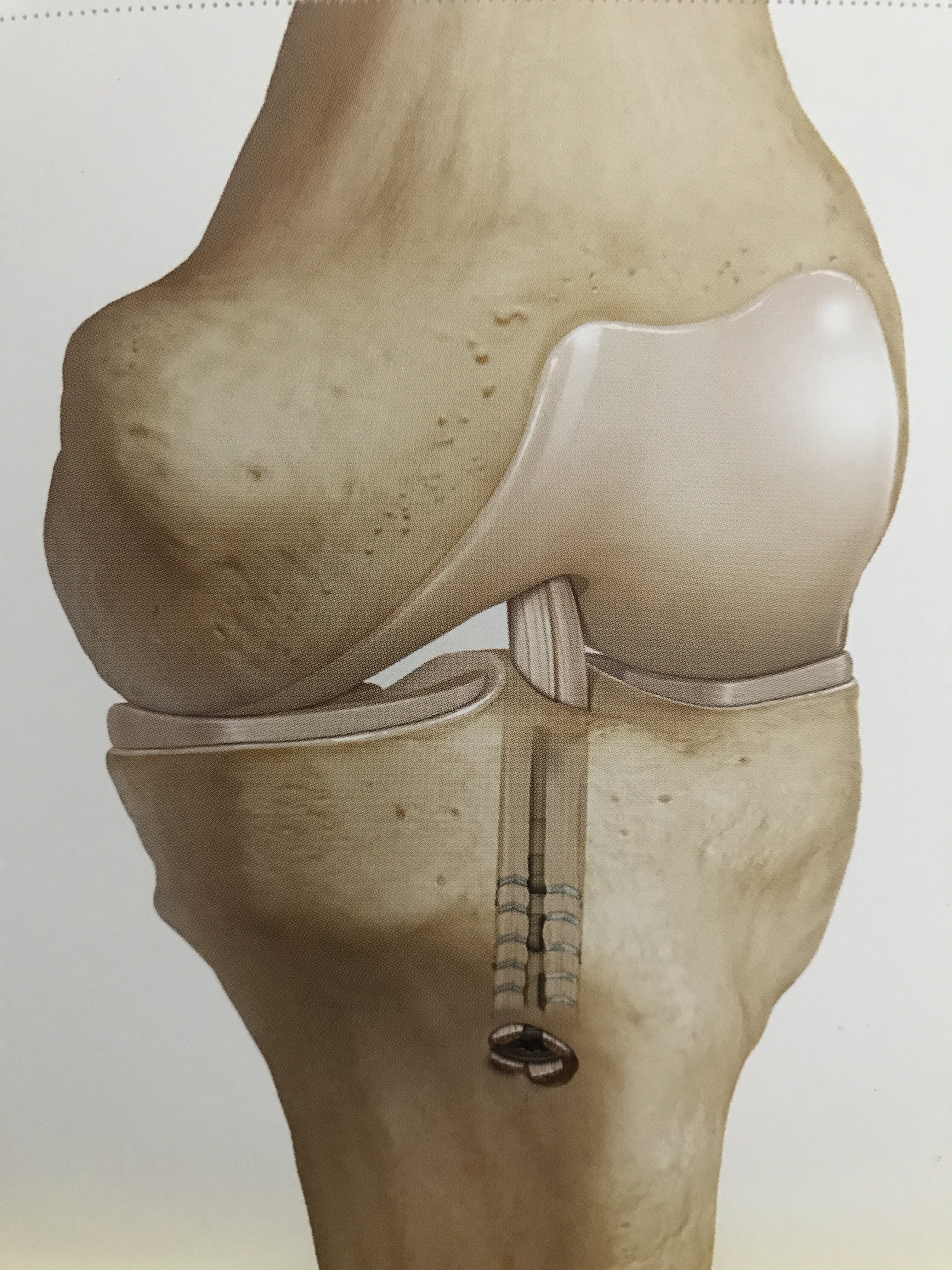 前交叉韧带acl损伤自体肌腱重建病例 好大夫在线 前交叉韧带acl损伤自体肌腱重建病例 好大夫在线