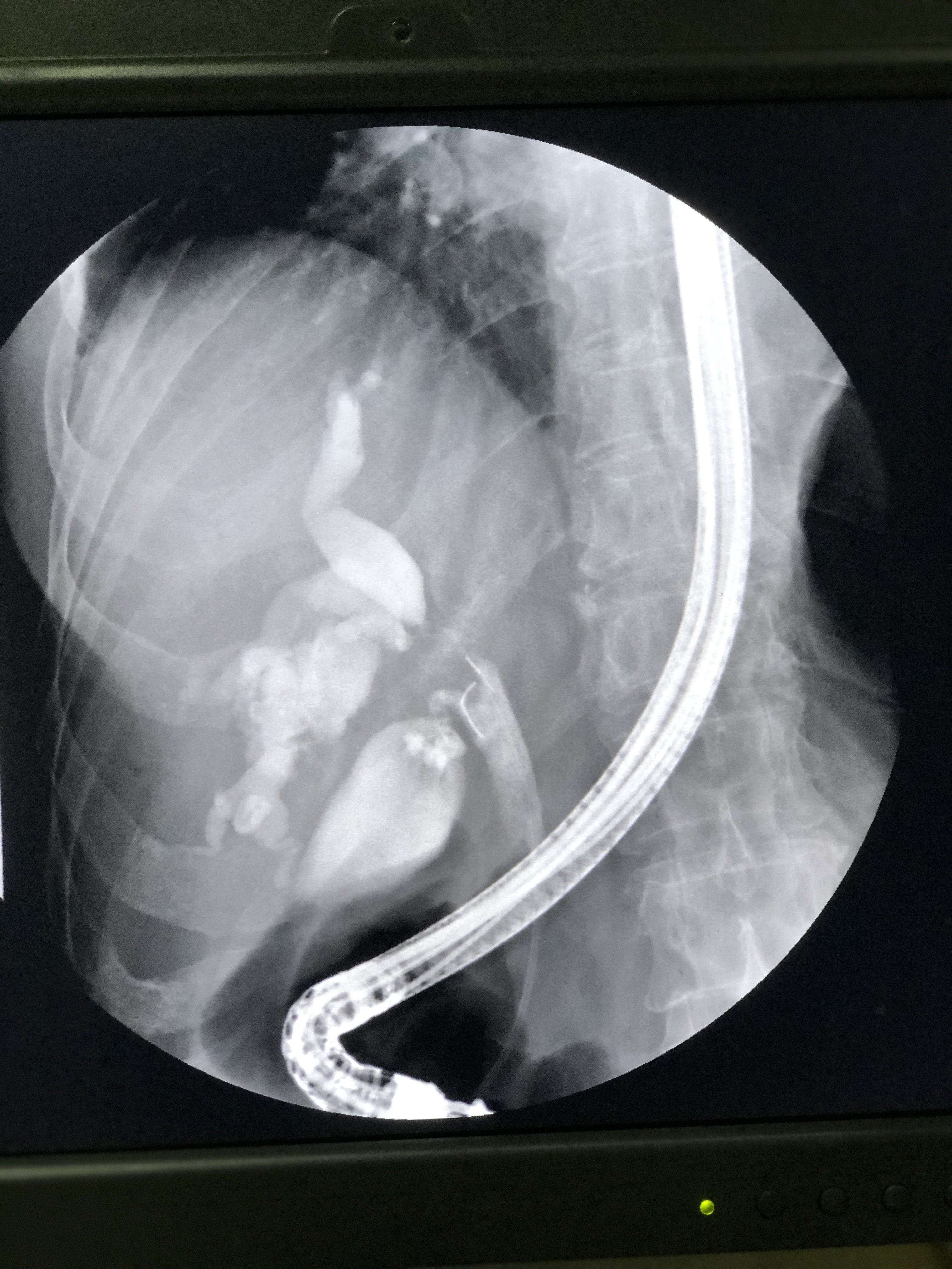 胆管支架手术图片