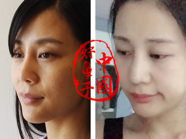 整容手术隆鼻视频_整容手术隆鼻多少钱_隆鼻整容手术