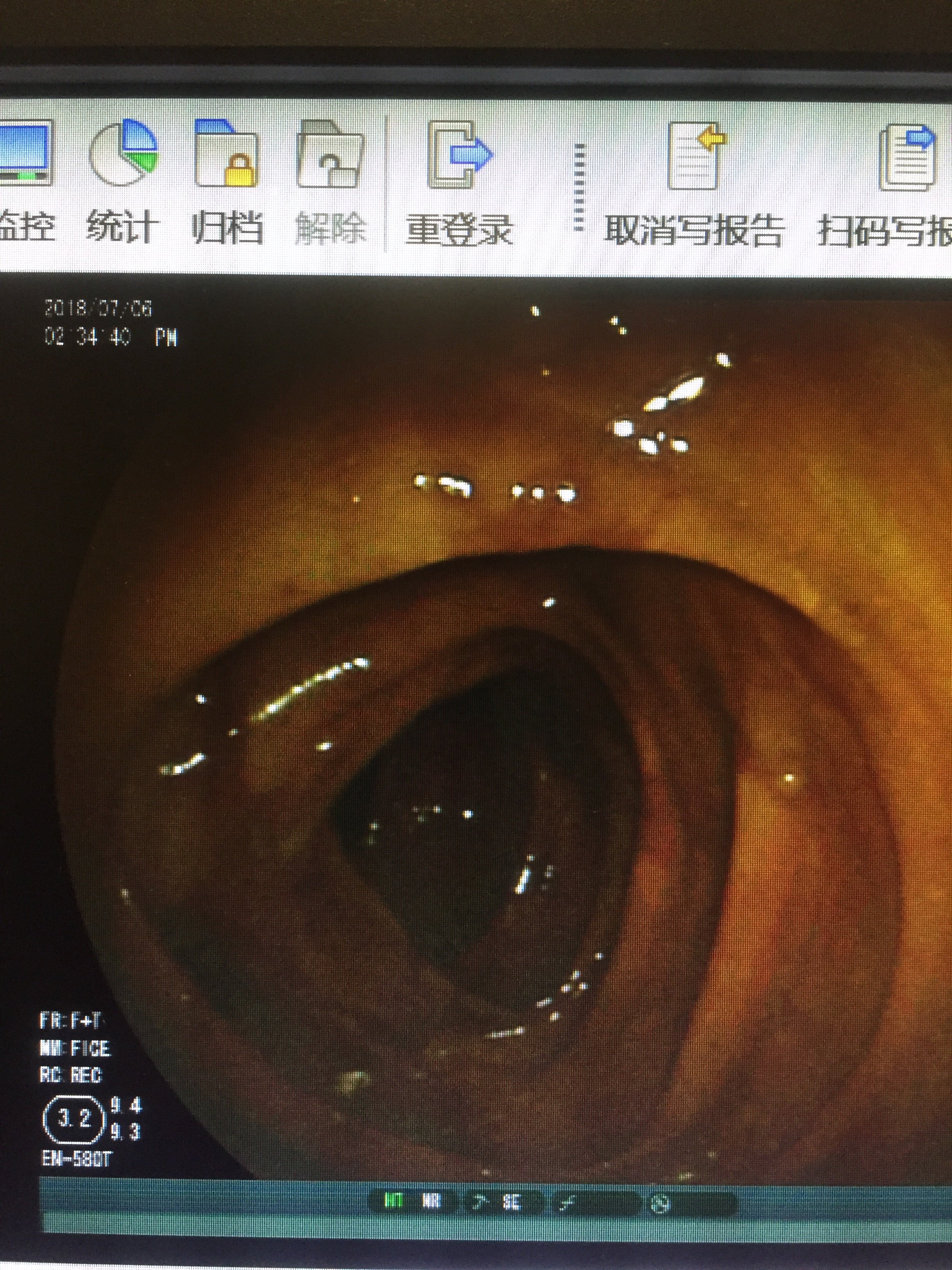 双气囊电子小肠镜图片