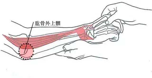 前臂伸肌腱牵拉试验图片