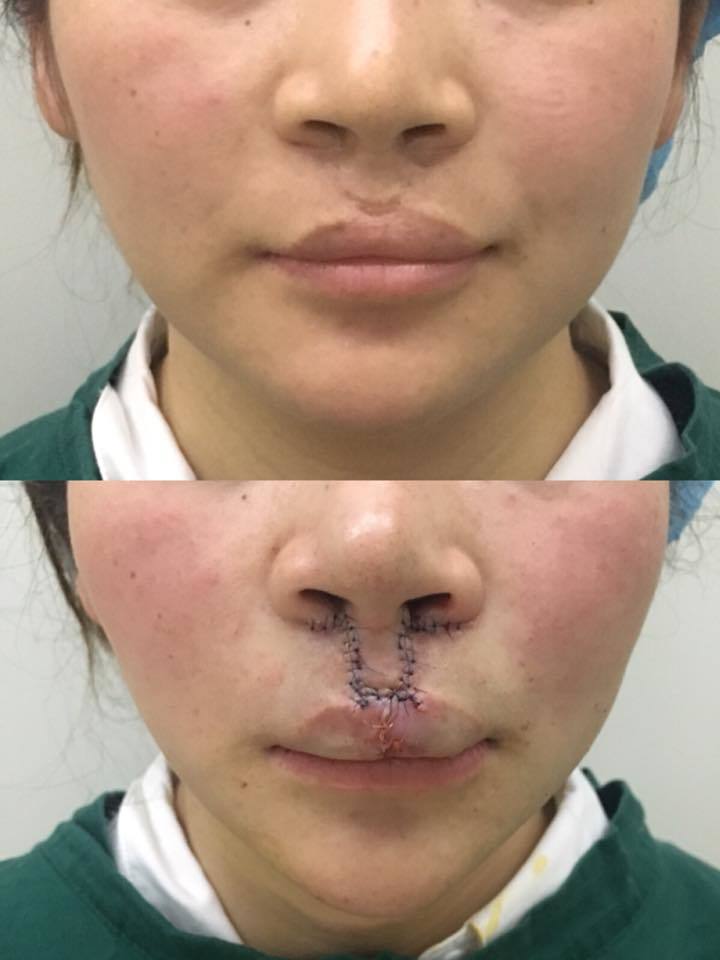 唇裂二次修复手术图片图片