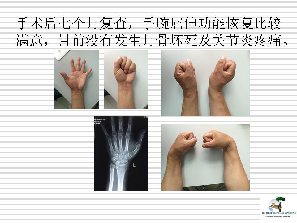 陈旧月骨周围脱位病例分享 - 好大夫在线